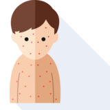  chickenpox - chickenpox